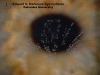 Recurrent granular dystrophy following penetrating keratoplasty and granular dystrophy with characteristic discrete, well demarcated crumb-like white-grey granules in the anterior central cornea.